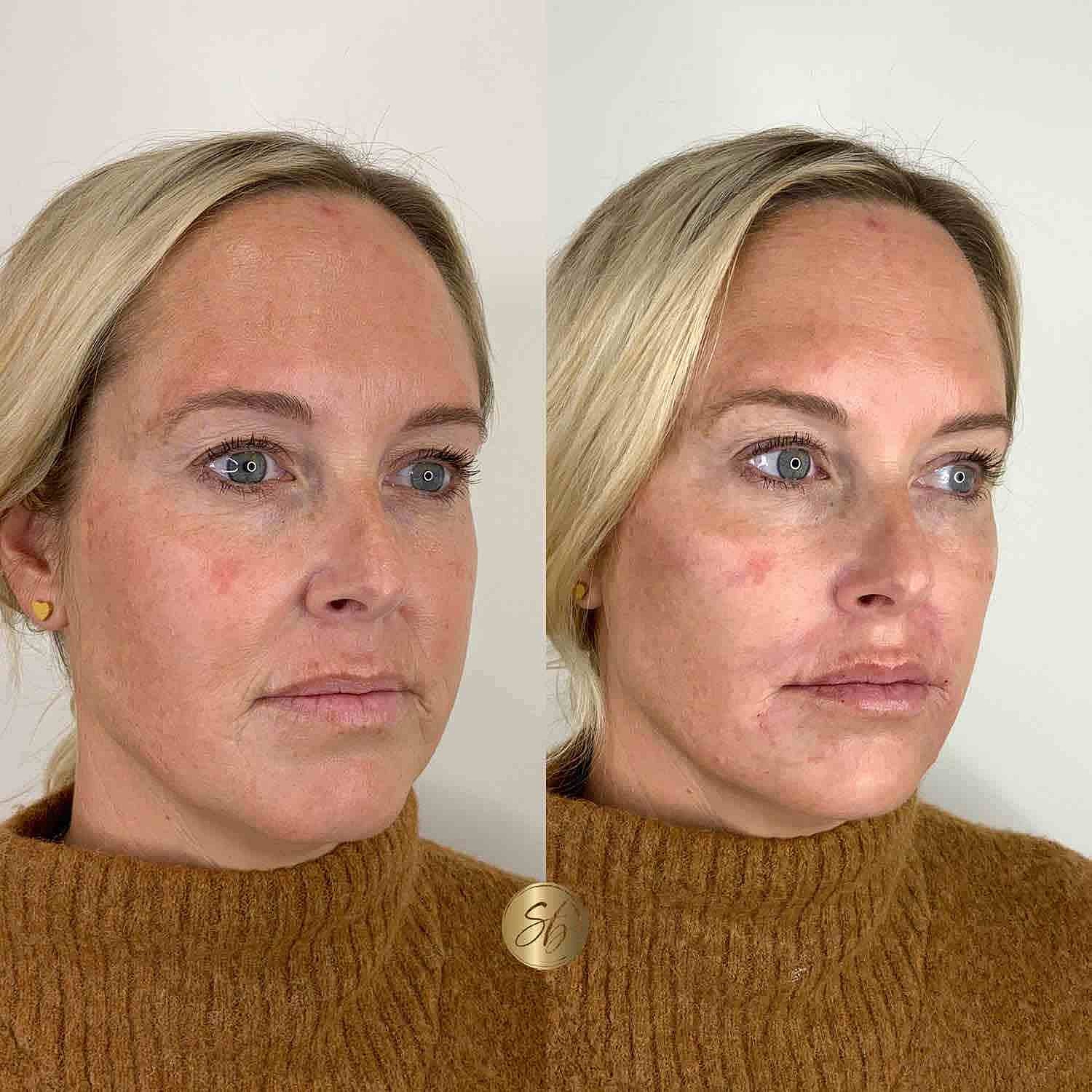 Facial Balancing Before & After