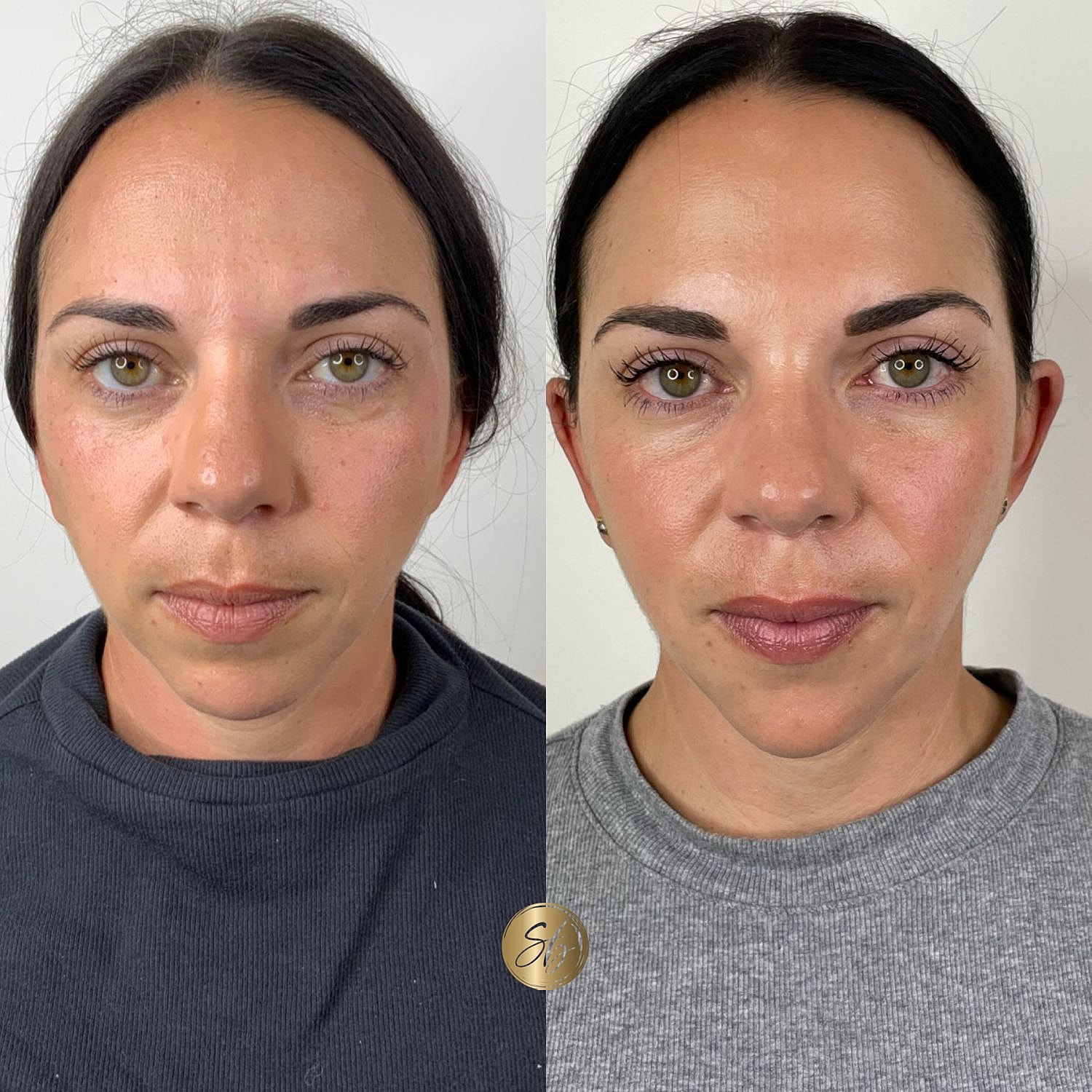 Facial Balancing Before & After