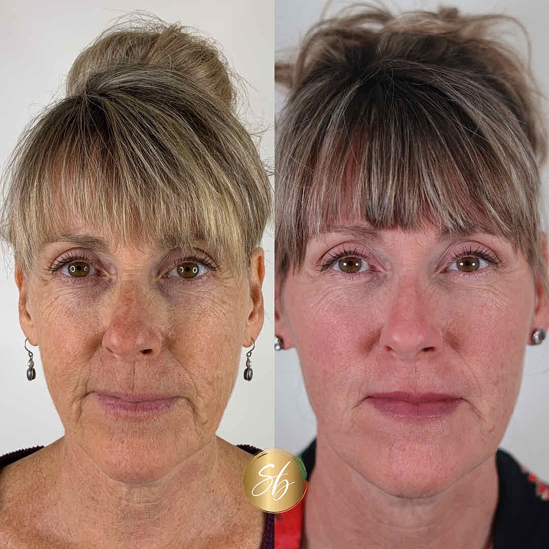 Facial Balancing Before & After