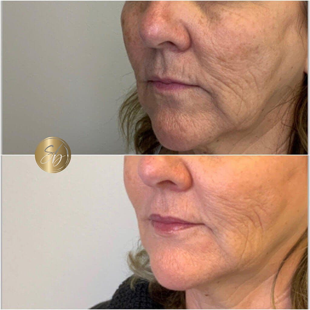 Facial Balancing Before & After