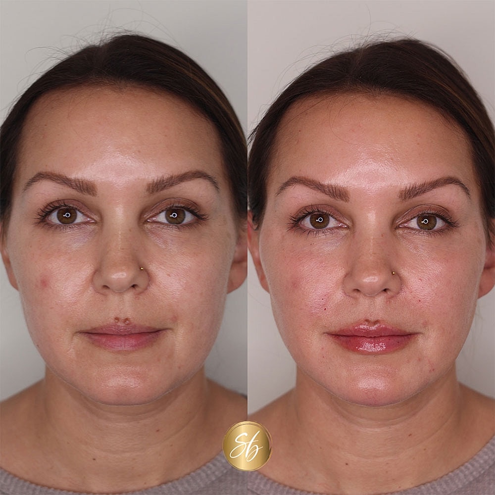 Before and after skincare treatment comparison.