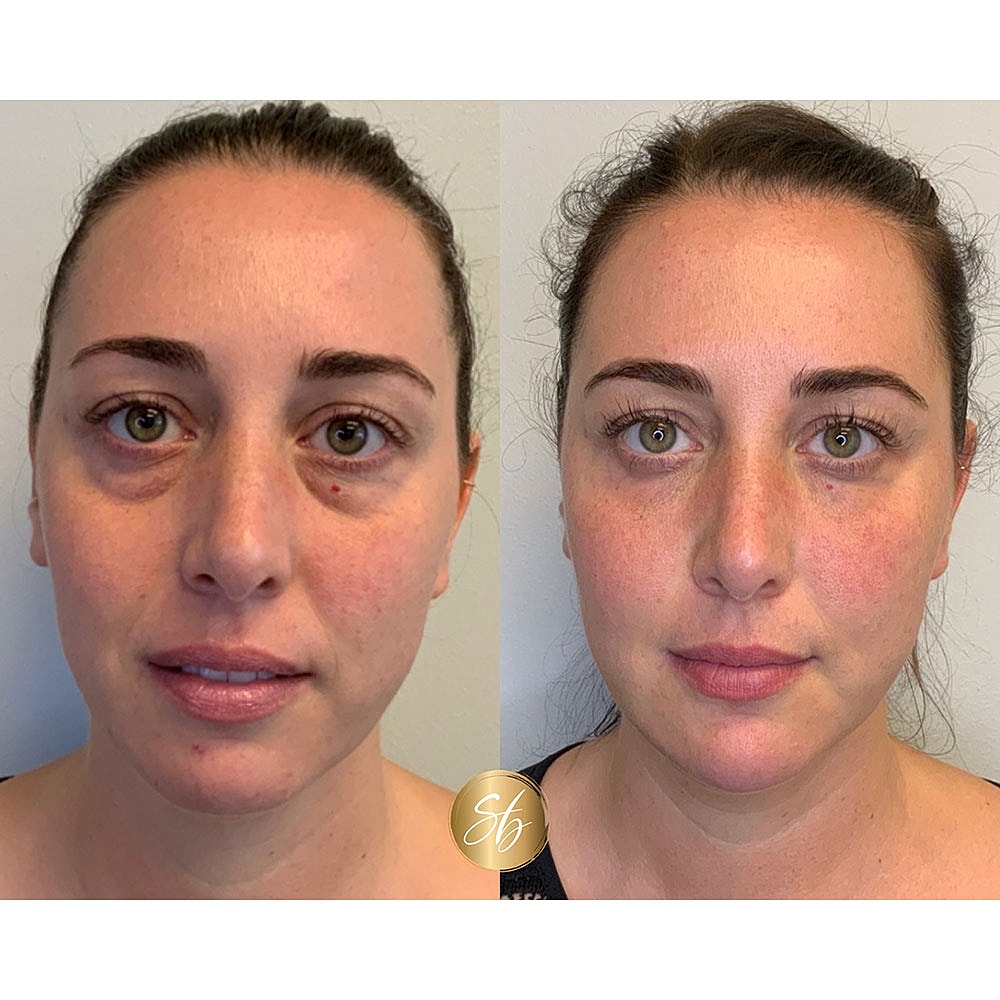 Before and after facial enhancement comparison.