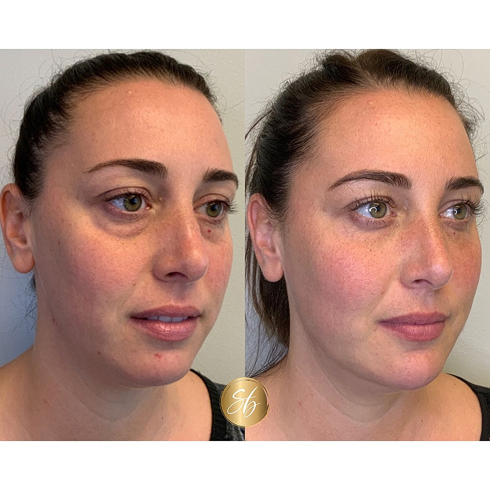 Before and after facial rejuvenation results.