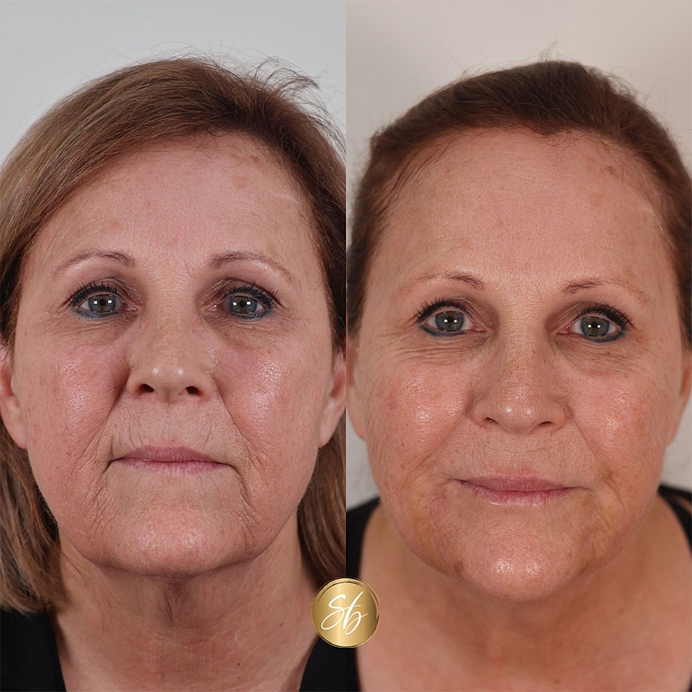 Before and after facial rejuvenation treatment comparison.