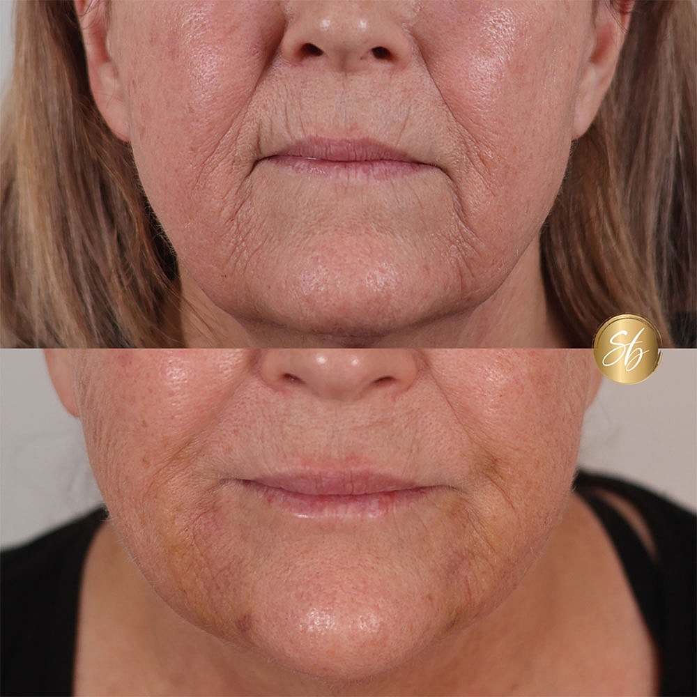 Before and after skin rejuvenation treatment comparison.
