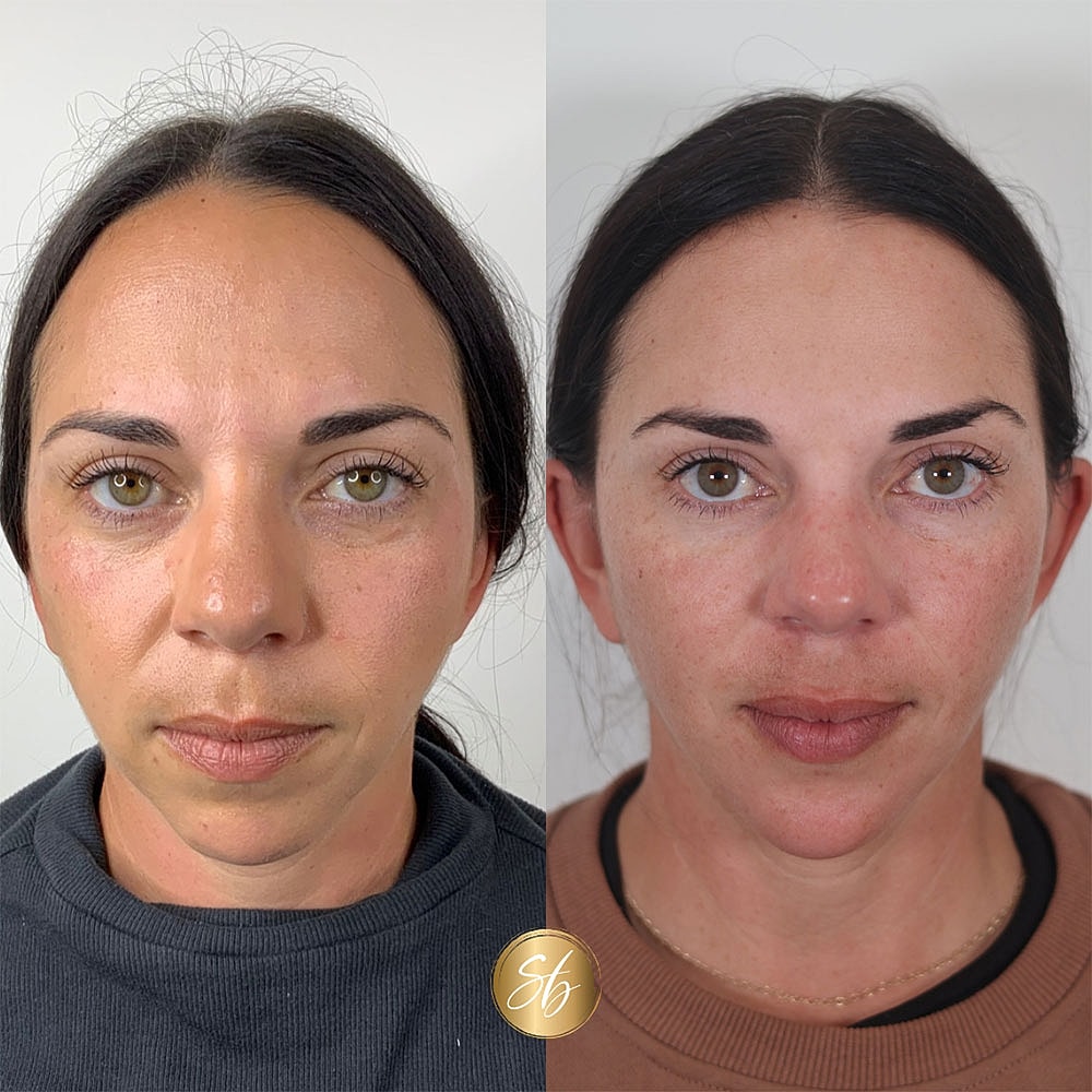Before and after facial treatment comparison.