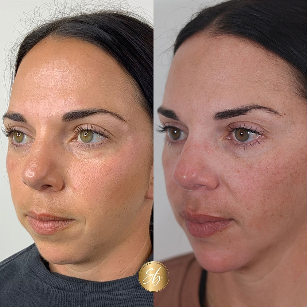 Before and after skincare treatment comparison.