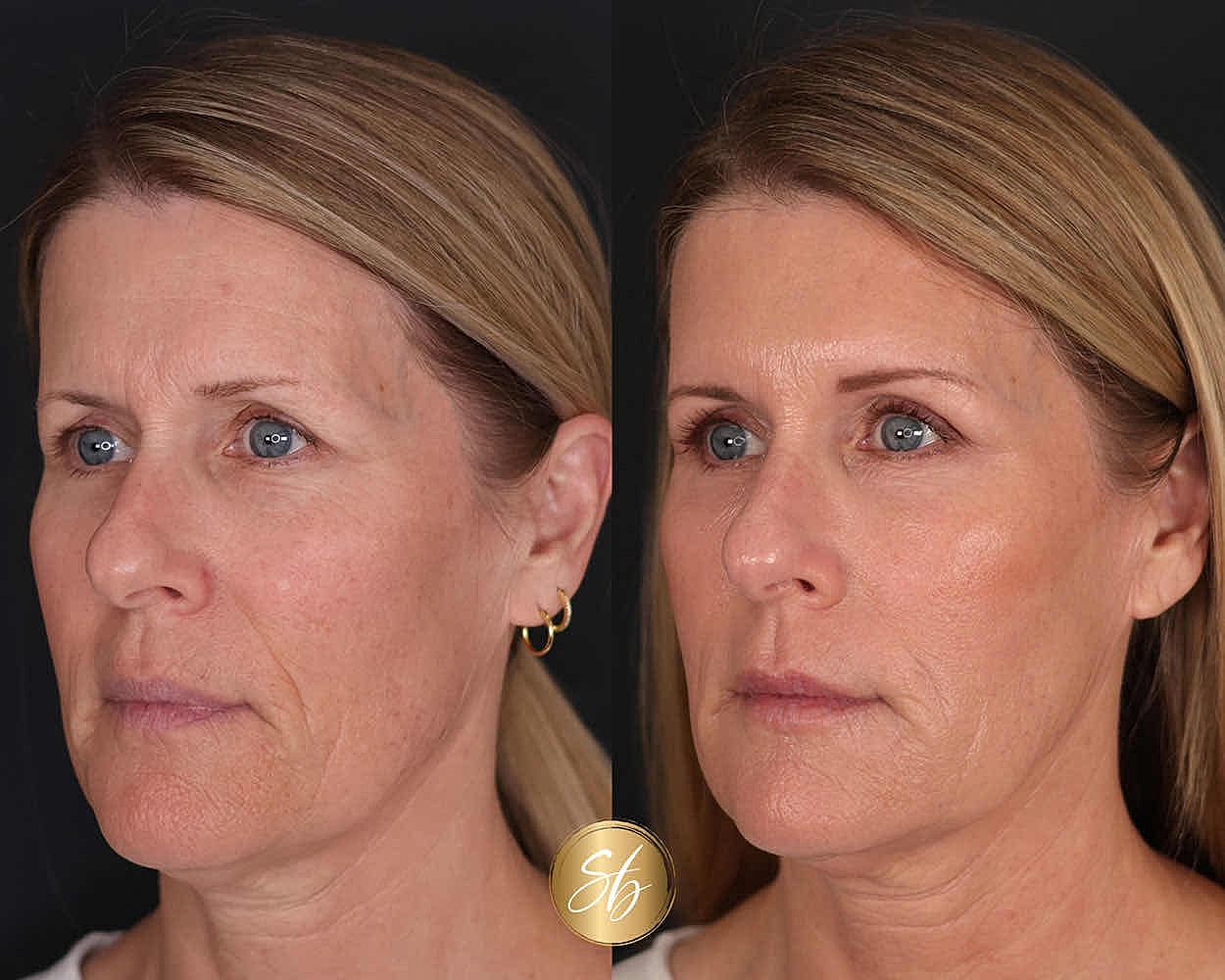 Before and after skincare treatment comparison.