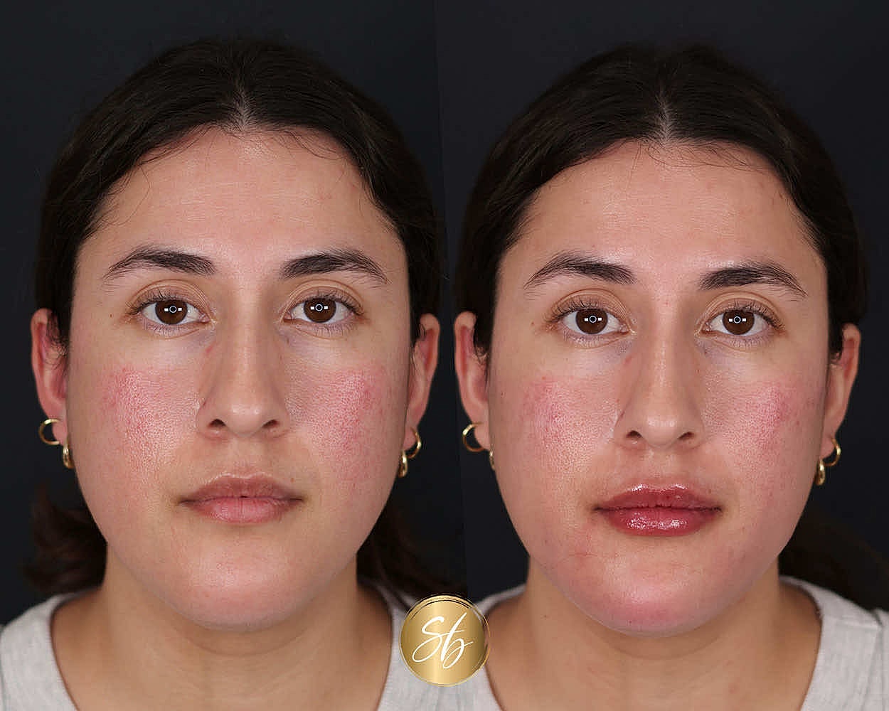Before and after skincare treatment comparison.