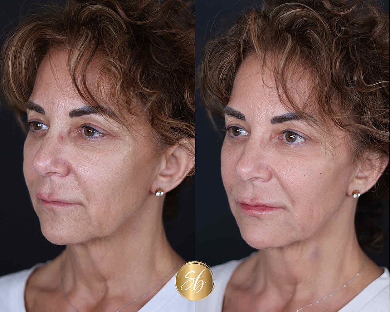 Before and after facial rejuvenation treatment.