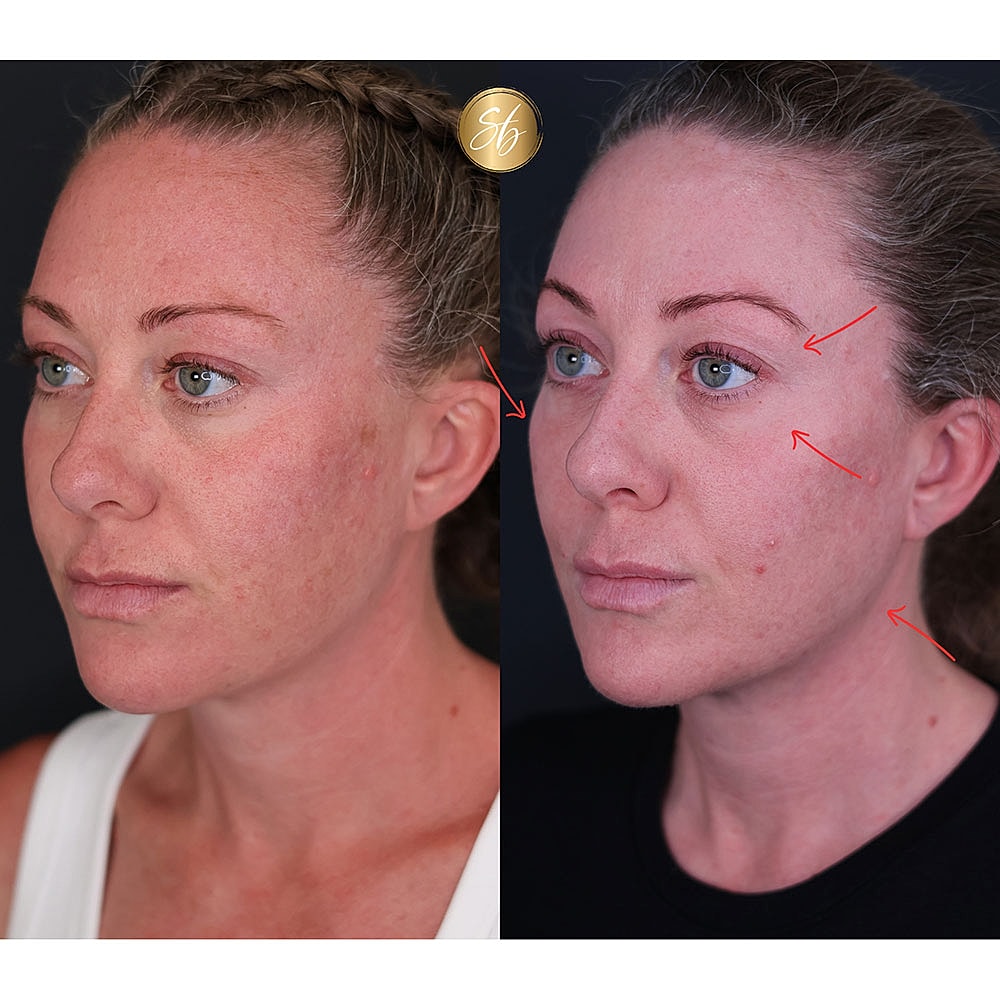 Before and after skincare comparison on female skin.