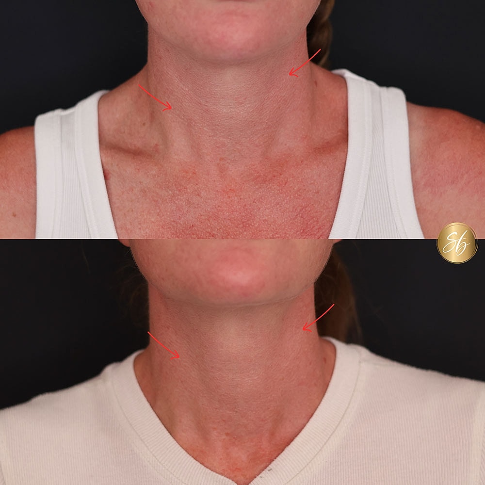 Before and after skin treatment comparison image.