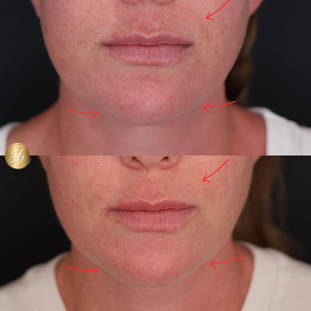 Before and after skin texture improvement comparison.