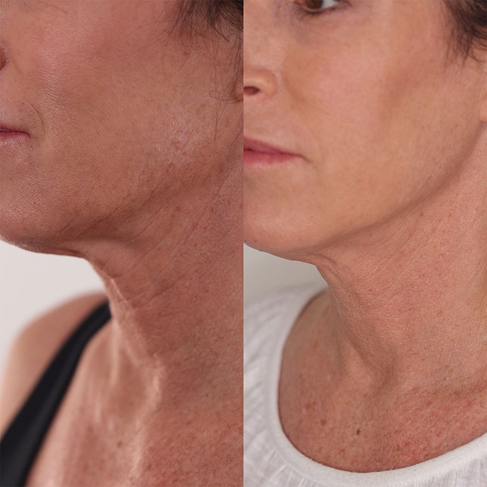 Before and after skin treatment results comparison.