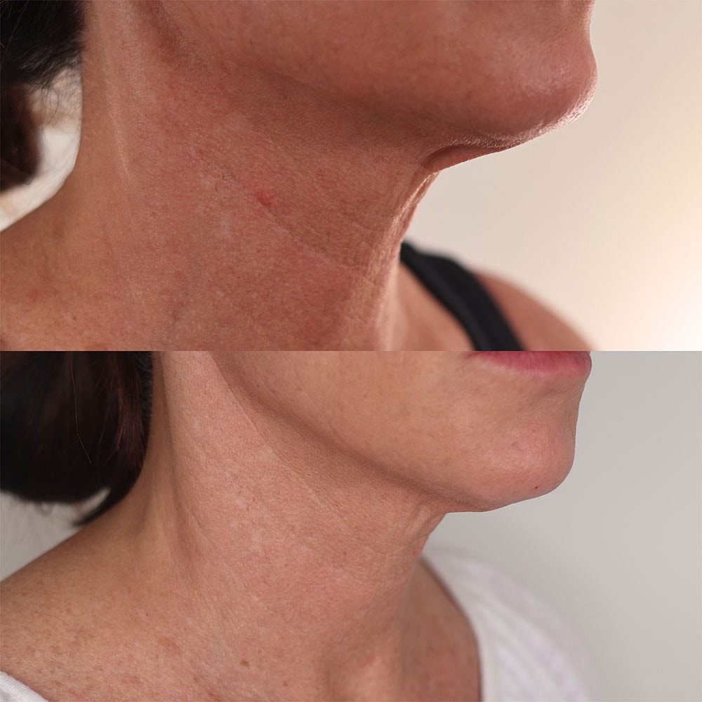 Skin comparison before and after treatment.