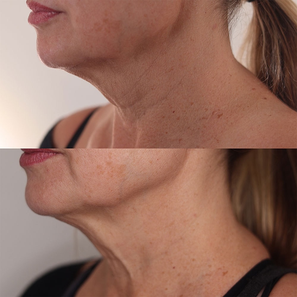 Before and after neck skin treatment comparison.