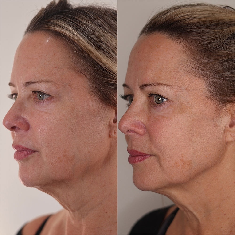 Before and after facial treatment comparison image.