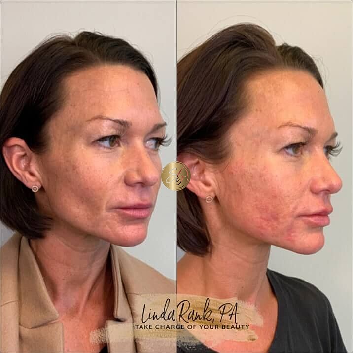 Lower Face Filler Before & After