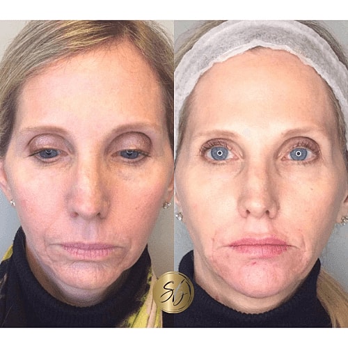 Lower Face Filler Before & After