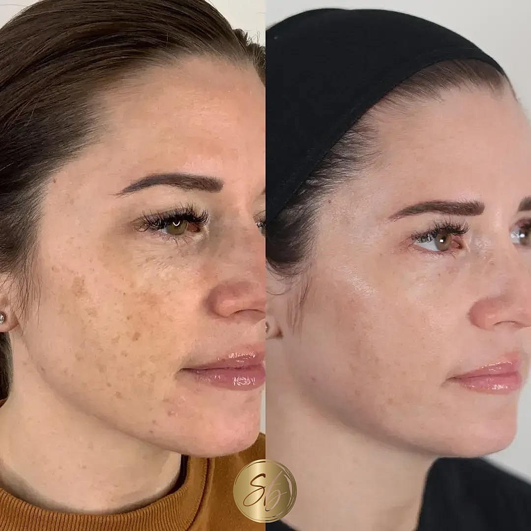BBL Laser Before & After