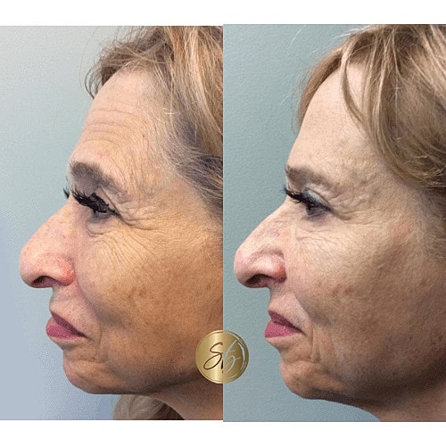 Botox Before & After