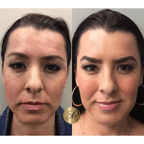 Botox Before & After