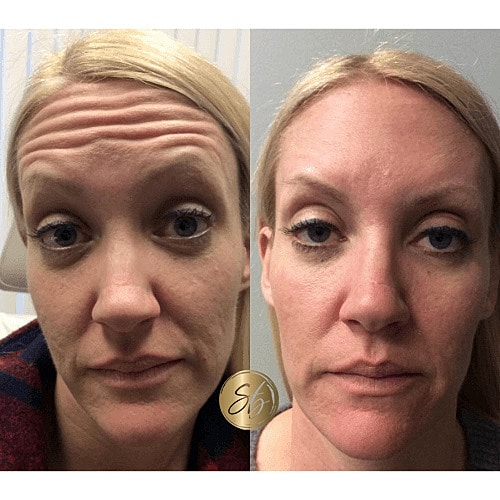 Botox Before & After