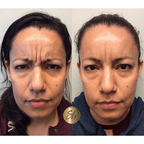 Botox Before & After