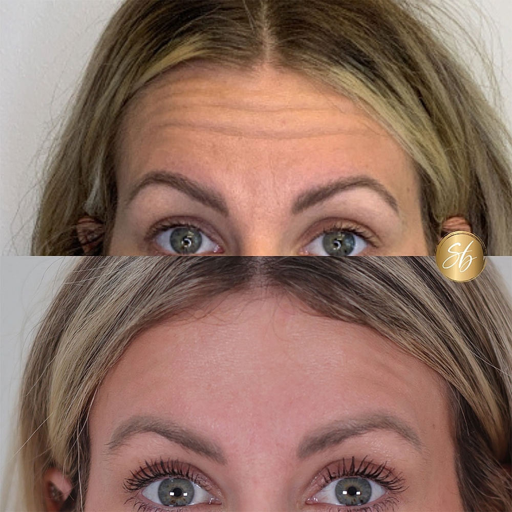 Before and after eyebrow treatment comparison image