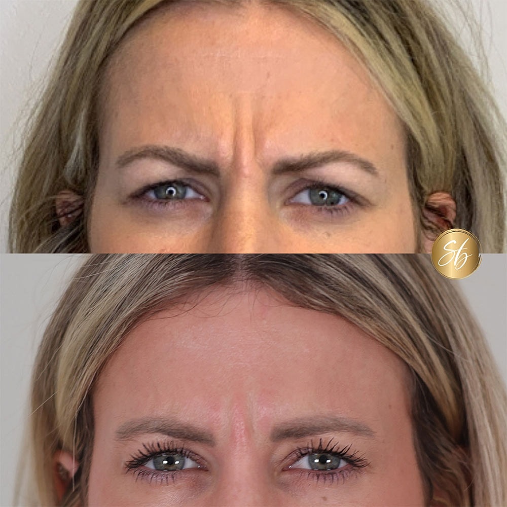 Before and after facial treatment results comparison.