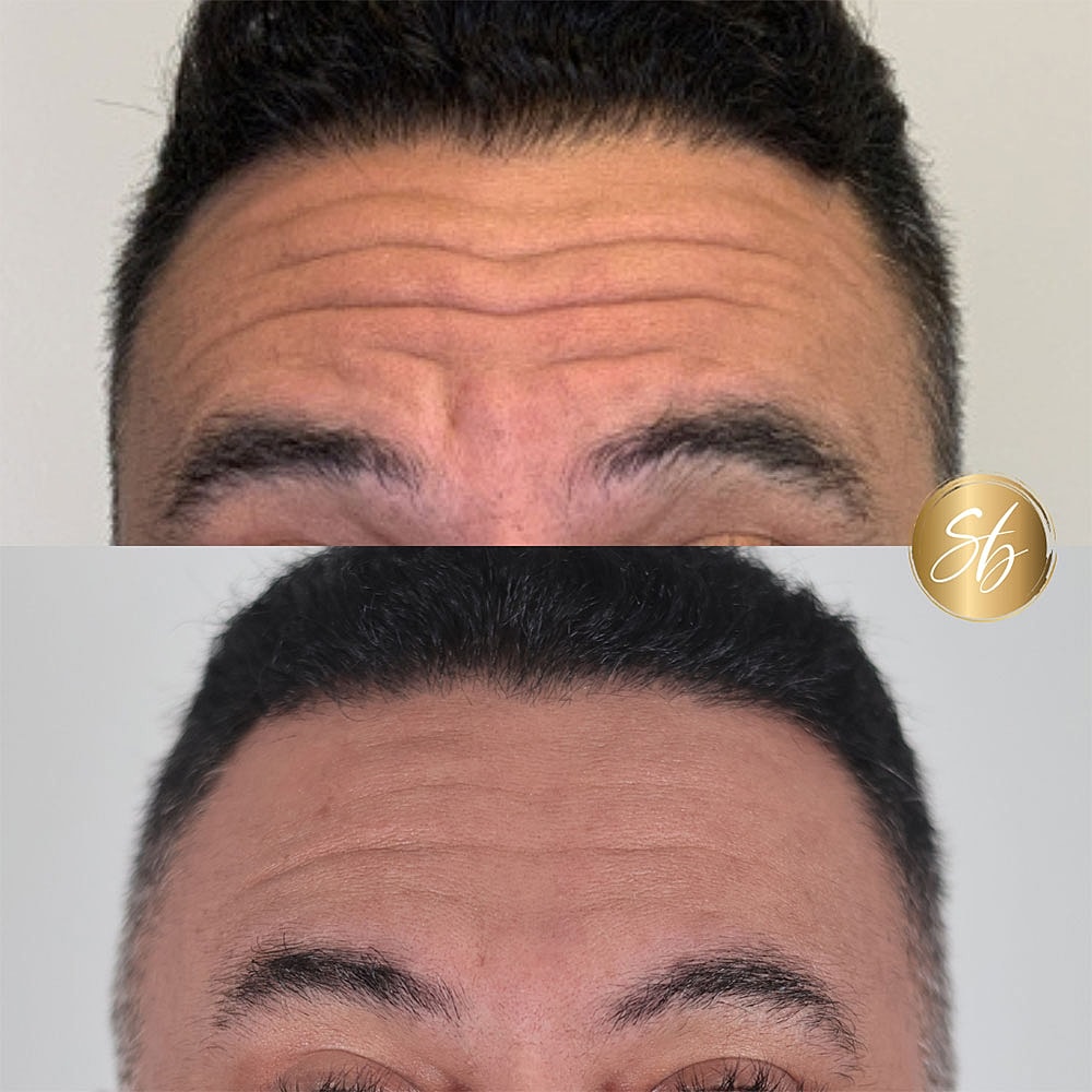Before and after hair restoration transformation.