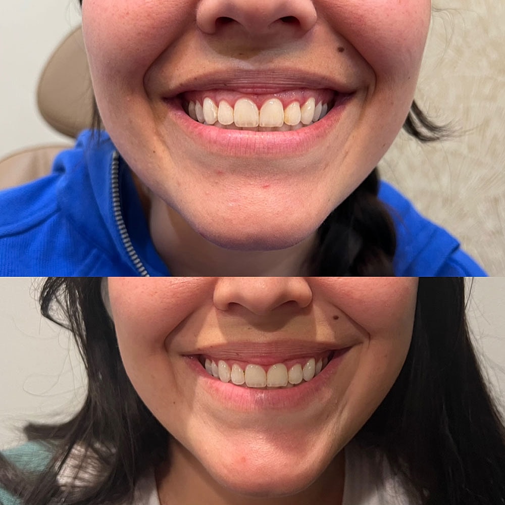 Before and after smile transformation photos.
