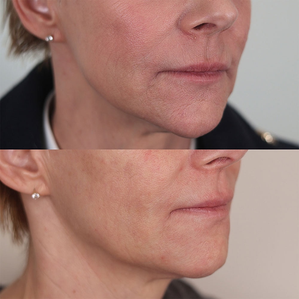 Before and after skin treatment comparison image.
