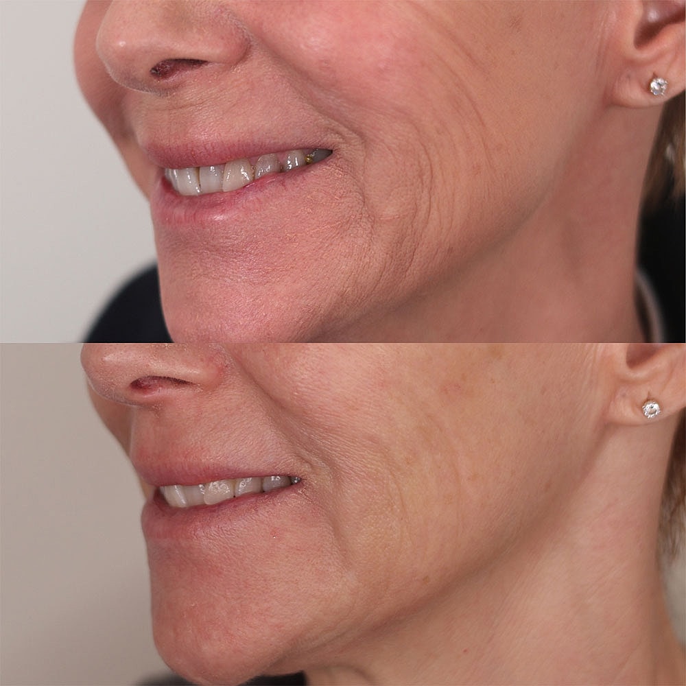 Before and after skin appearance comparison.