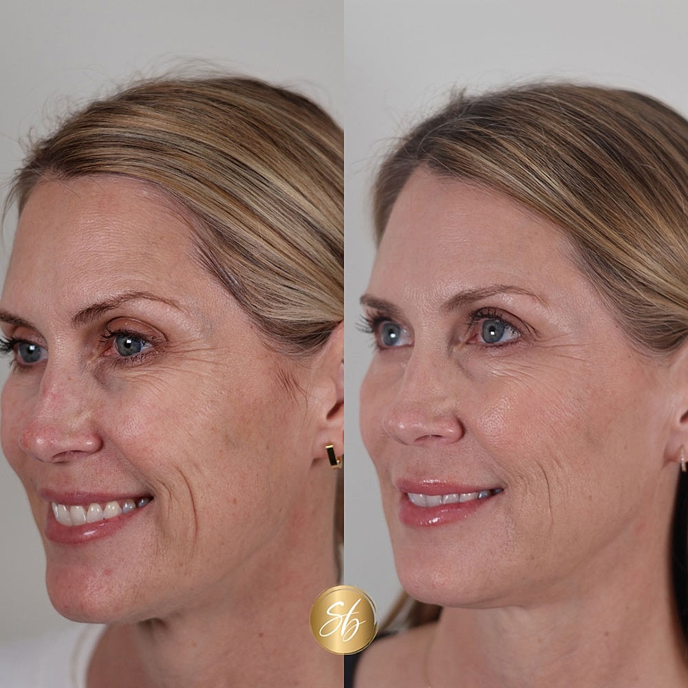 Before and after skincare treatment comparison.