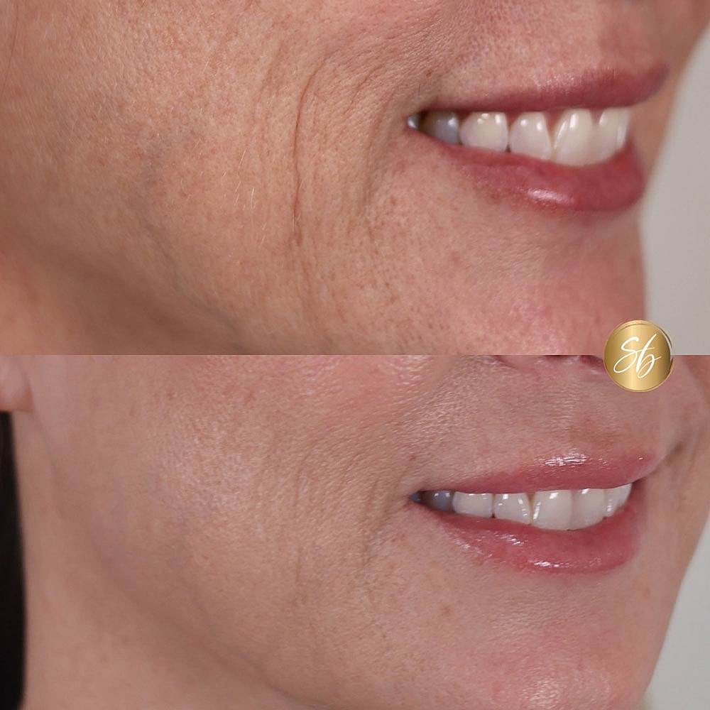 Before and after skincare treatment comparison.