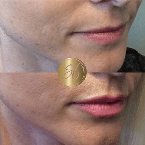 Lip Fillers Before & After