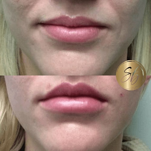 Lip Fillers Before & After