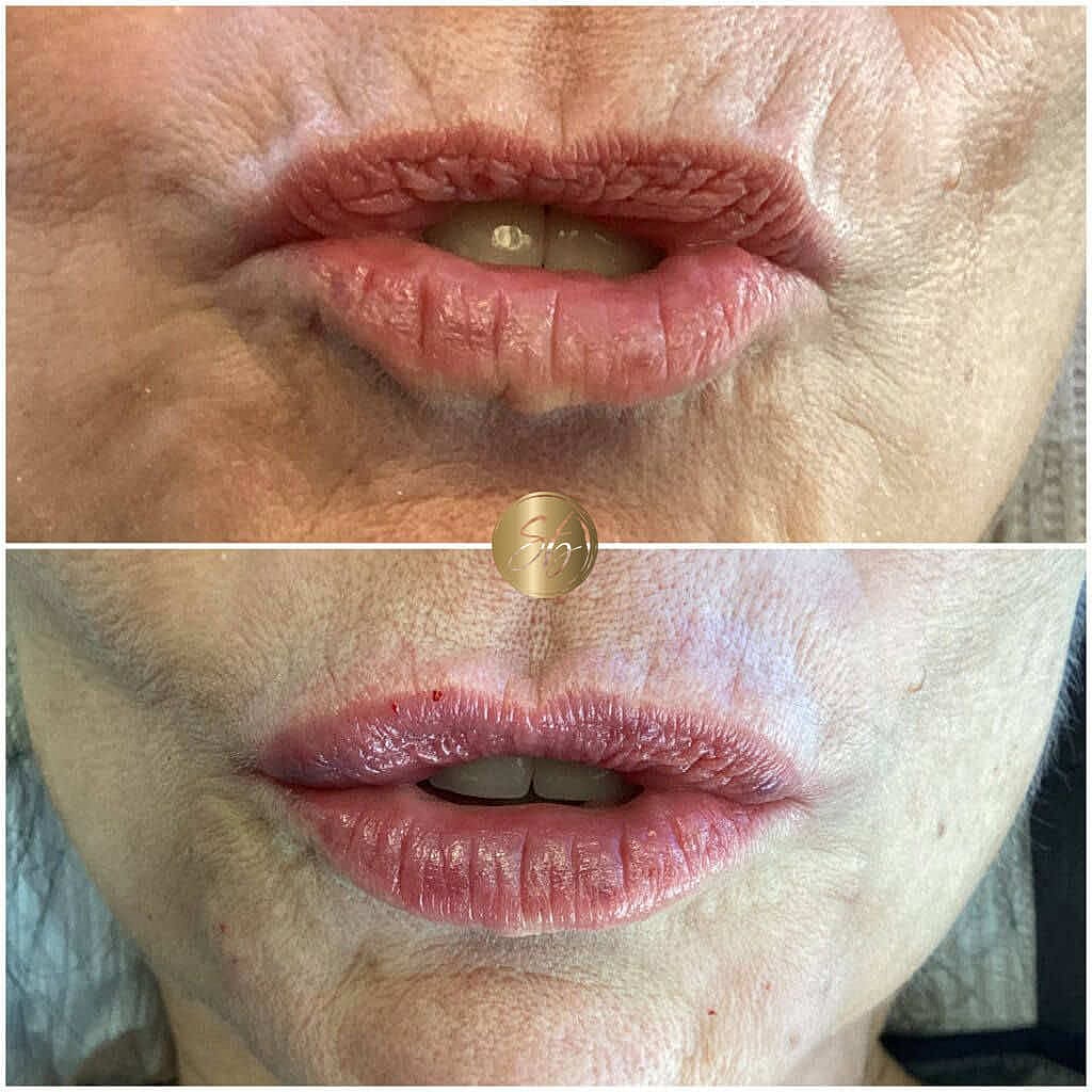 Lip Fillers Before & After