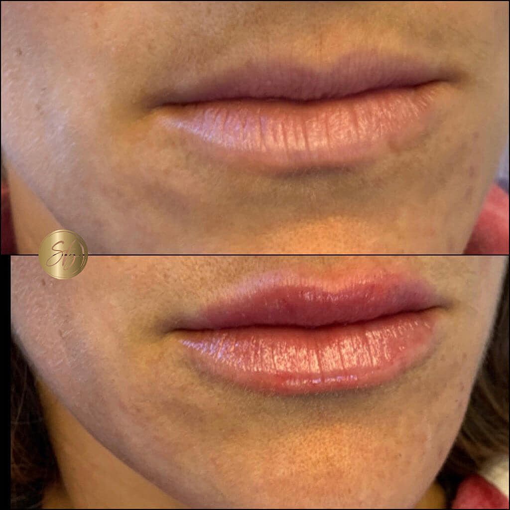 Lip Fillers Before & After