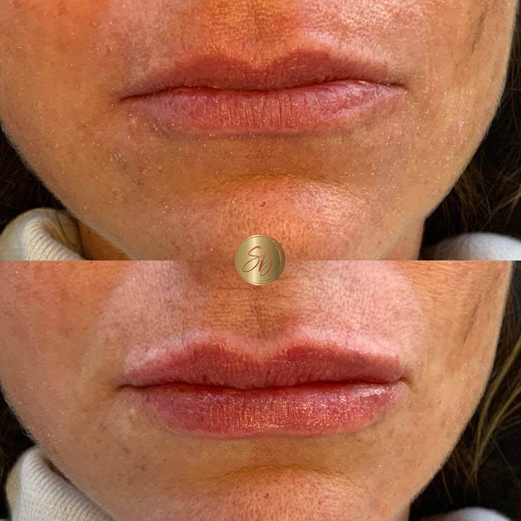 Lip Fillers Before & After