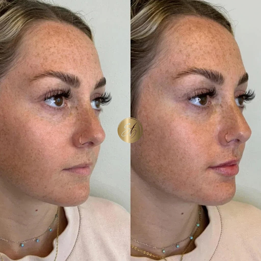 Lip Fillers Before & After