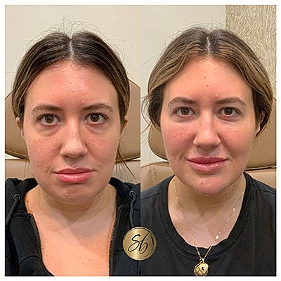 Lip Fillers Before & After