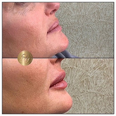 Lip Fillers Before & After