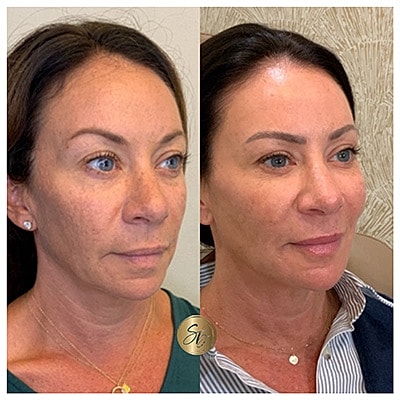 Lip Fillers Before & After