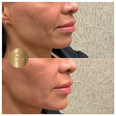 Lip Fillers Before & After