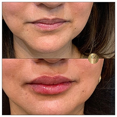 Lip Fillers Before & After