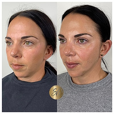 Lip Fillers Before & After