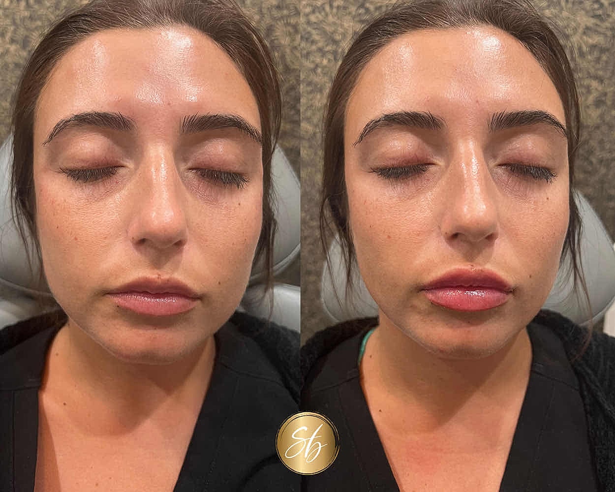 Before and after lip enhancement treatment process.