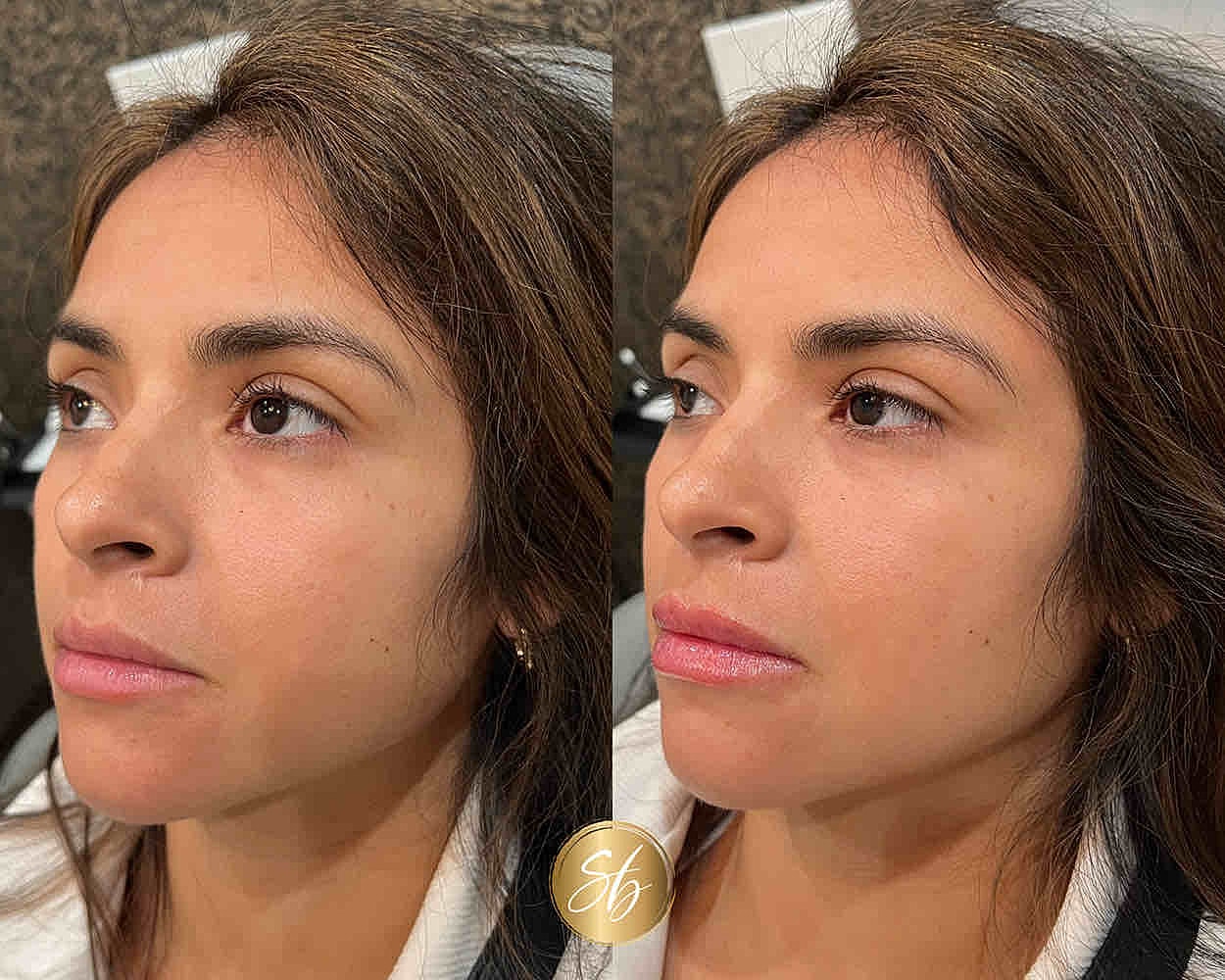 Before and after facial treatment comparison.